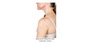 Back Acne Prevention and Treatment Tactics