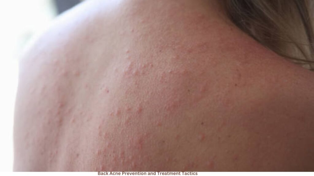 Back Acne Prevention and Treatment Tactics