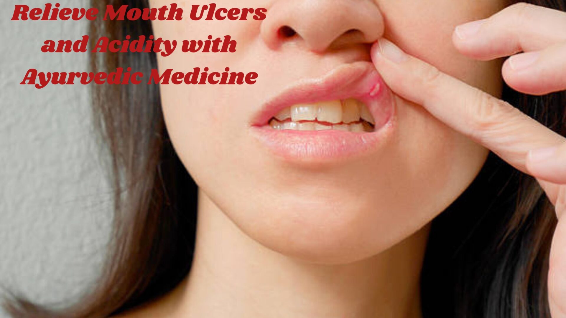 Relieve Mouth Ulcers and Acidity with Ayurvedic Medicine