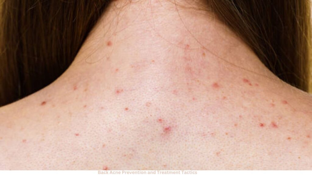 Back Acne Prevention and Treatment Tactics
