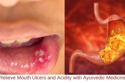 Relieve Mouth Ulcers and Acidity with Ayurvedic Medicine
