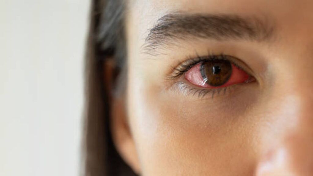Comman Eye Conditions: Causes, Symptoms, and Treatment Options
